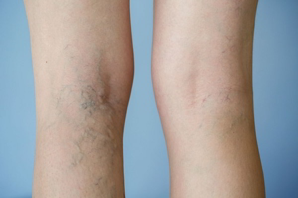 làm sao để cải thiện suy giảm tĩnh mạch