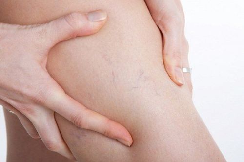 Cải thiện suy giảm tĩnh mạch