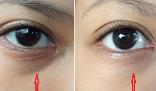 Phương pháp giảm quầng thâm mắt tại nhà