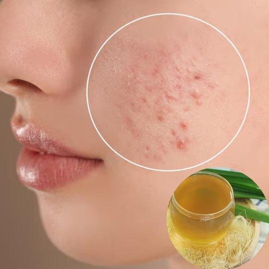 Nước râu ngô giải độc gan hỗ trợ cải thiện mụn