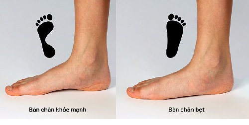 Dấu hiệu nhận biết bàn chân bẹt