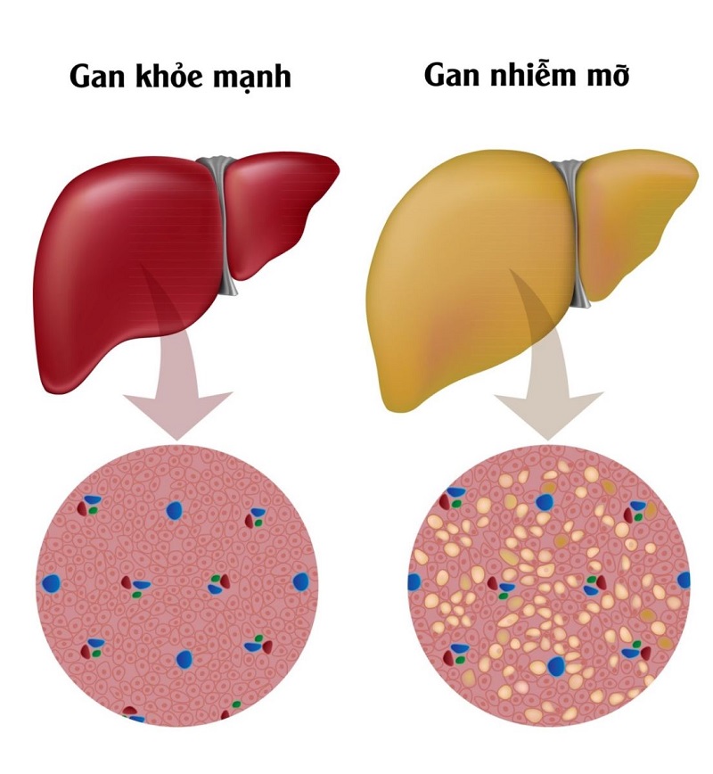 Gan nhiễm mỡ là gì?