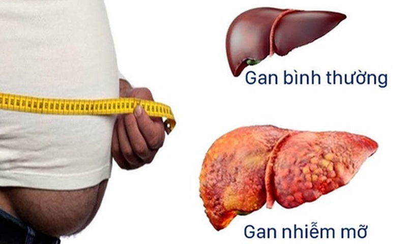 Thăm khám bác sĩ khi bị gan nhiễm mỡ