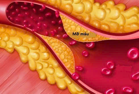 Nụ vối khô giảm mỡ máu hiệu quả
