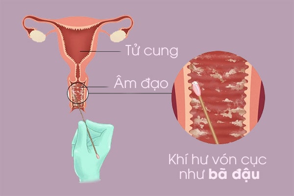 Khí hư vón cục tại âm đạo