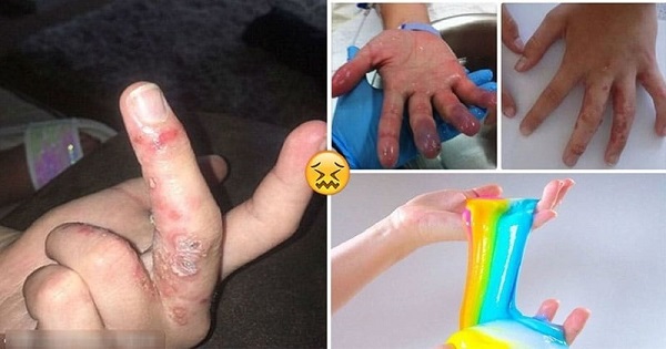 Tình trạng phù động mạch sau khi chơi slime