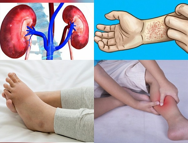 Các dấu hiệu thận suy yếu cần đi thăm khám bác sĩ