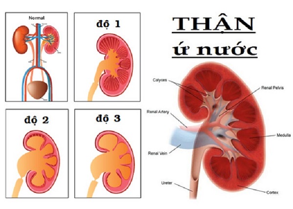 Các cấp độ thận ứ nước