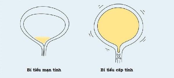 Bí tiểu nguy hiểm