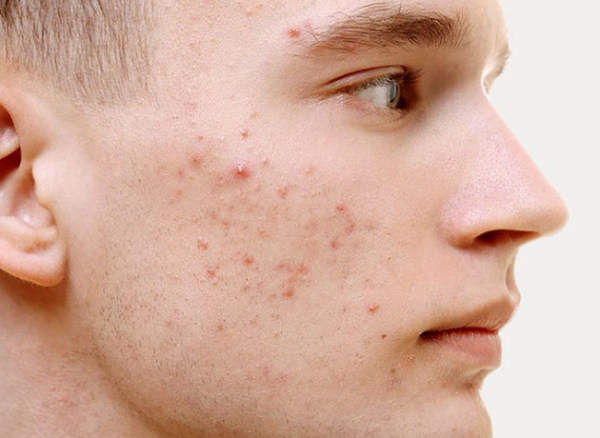 Bột quế dưỡng da sáng khỏe