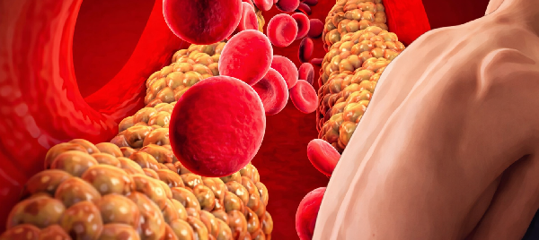 Các yếu tố dẫn tới mỡ máu