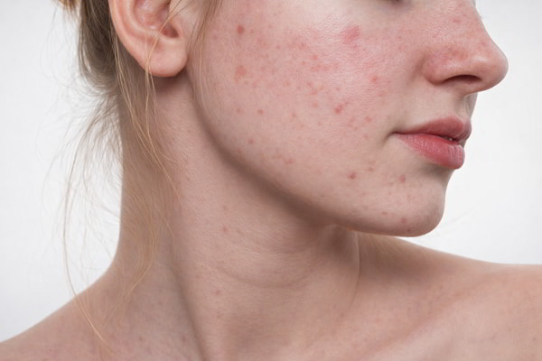 Da xấu vì thường xuyên ăn ngọt