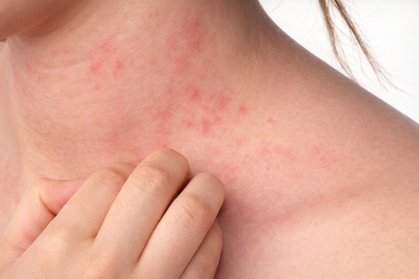 Mẩn ngứa không rõ nguyên nhân
